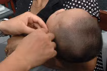 Thực hư phương pháp thổi bột nhau thai, khói hương chữa viêm tai