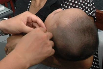 Thực hư phương pháp thổi bột nhau thai, khói hương chữa viêm tai