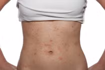 Dị ứng mỹ phẩm có nguy hiểm?