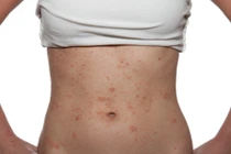 Dị ứng mỹ phẩm có nguy hiểm?