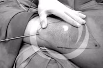 Phẫu thuật cắt toàn bộ tuyến mồ hôi nách