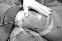 Phẫu thuật cắt toàn bộ tuyến mồ hôi nách