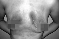 Suýt chết vì bơm silicon nâng ngực