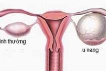 Nang buồng trứng ở trẻ dậy thì có nguy hiểm?