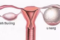 Nang buồng trứng ở trẻ dậy thì có nguy hiểm?