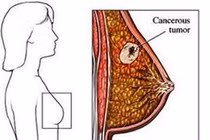 Có tái phát hạch vùng sau ung thư vú?