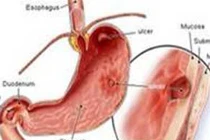 Yếu tố gây ung thư dạ dày 