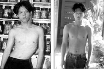 Dùng thuốc bổ, giảm 85% vẹo cột sống