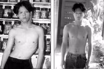 Dùng thuốc bổ, giảm 85% vẹo cột sống