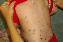 Kiêng cữ cho trẻ khi thủy đậu