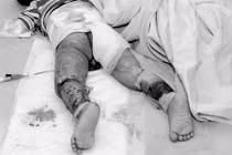 Rắc kháng sinh lên vết bỏng dễ sốc phản vệ 