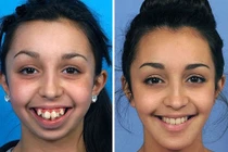 9X “vịt hóa thiên nga” nhờ dao kéo tự tin thi hoa hậu