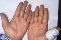 Mắc ung thư biểu mô tế bào vảy vì dùng thạch tín điều trị hen