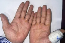 Mắc ung thư biểu mô tế bào vảy vì dùng thạch tín điều trị hen