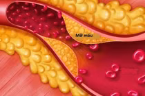 Kinh ngạc loại rau gây mỡ máu không kém thịt, người bệnh tránh xa