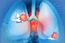 Giật mình dấu hiệu ở đầu cảnh báo ung thư phổi ít người biết