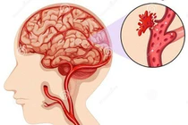 Dấu hiệu cảnh báo xuất huyết não - “kẻ giết người nhanh nhất”