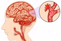 Dấu hiệu cảnh báo xuất huyết não - “kẻ giết người nhanh nhất”