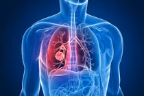 Dấu hiệu bất thường ở chân cảnh báo ung thư phổi, 90% không biết