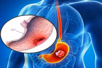 Ăn 4 thực phẩm này, ung thư dạ dày sớm muộn cũng “gõ cửa”