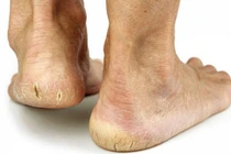 Giật mình lý do gót chân nứt nẻ, không hẳn vì thiếu nước