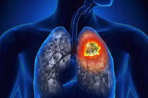 Chàng trai 20 tuổi mắc ung thư phổi: Chuyên gia chỉ cách phòng bệnh