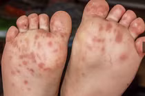 Bệnh tay chân miệng bùng phát: Biến chứng nguy hiểm sao?