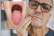 Bất ngờ dấu hiệu ở lưỡi cảnh báo bạn mắc ung thư 