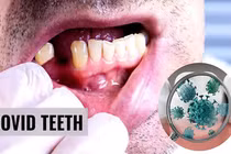 Bất ngờ dấu hiệu ở miệng cảnh báo bạn mắc COVID-19