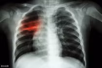 Dấu hiệu buổi sáng cảnh báo ung thư phổi, khám ngay kẻo hối hận