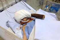 Bé trai 11 ngày tuổi bị đâm xuyên đầu vẫn nguy kịch