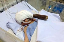 Bé trai 11 ngày tuổi bị đâm xuyên đầu vẫn nguy kịch