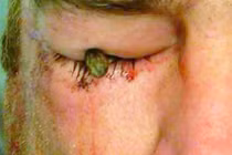 Bị cây đinh dài 7cm đâm vào mắt vẫn nhìn bình thường