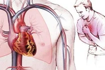 Xơ vữa động mạch gây ra đột quỵ não