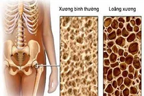 Đối phó với chứng đau nhức xương khớp ở người cao tuổi 