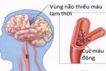 Kết hợp Đông, Tây y điều trị thiểu năng tuần hoàn não 