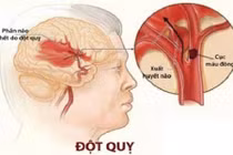 Sơ cứu đúng cách khi bị đột quỵ