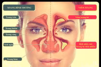 Biến chứng nguy hiểm của viêm xoang 