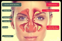 Biến chứng nguy hiểm của viêm xoang 