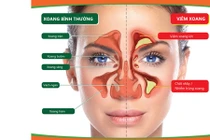 Triệu chứng của bệnh viêm xoang