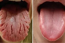 Các dấu hiệu cảnh báo bệnh trên lưỡi