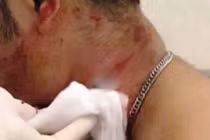 Mâu thuẫn nhỏ, nhóm côn đồ cứa cổ 3 công nhân suýt chết