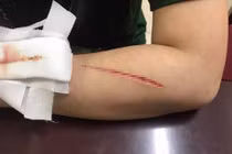 Ngỡ ngàng sự thật chuyện thiếu nữ bị cướp rạch tay ở Hà Nội