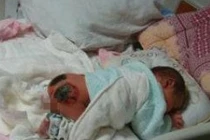 Bé gái 17 tháng bỏng nặng vì... bom xăng