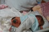 Bé gái 17 tháng bỏng nặng vì... bom xăng