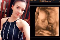 Chân dài Hồng Quế ốm nghén, lo vì thai nhi nhẹ cân