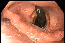 Vắt dài 10 cm ngọ nguậy trong khí quản bệnh nhân