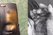 Thanh niên 19 tuổi phải cắt bỏ 3 ngón tay vì điện thoại phát nổ