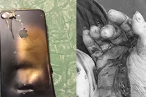 Thanh niên 19 tuổi phải cắt bỏ 3 ngón tay vì điện thoại phát nổ