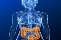 Aspirin giúp bệnh nhân ung thư đại tràng kéo dài sự sống